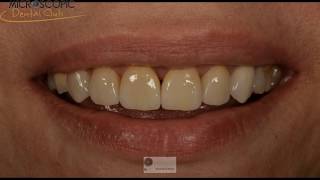 Laminate veneers from preparation to cementation [upl. by Aicrop232]