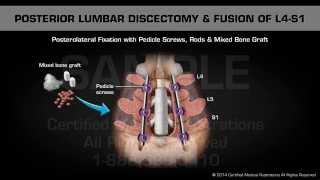 Posterior Lumbar Discectomy amp Fusion of L4S1 [upl. by Eisus]