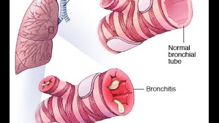 Wheeze Bronchiolitis [upl. by Adihaj]