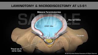 Laminotomy amp Microdiscectomy at L5S1 [upl. by Suiram]