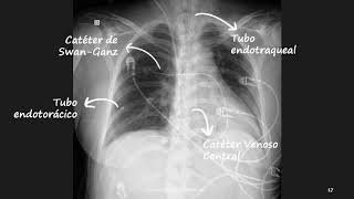 Tubos y lineas en la Radiografía de Tórax [upl. by Llemej]