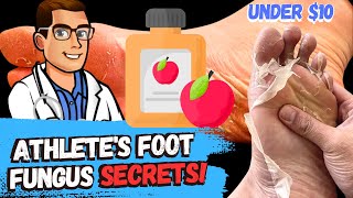 Athletes Foot Fungus Cure Apple Cider Vinegar Treatment [upl. by Tobin]