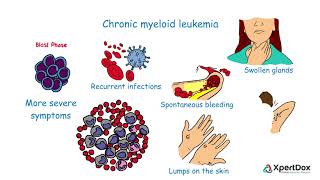 What is Chronic myeloid leukemia [upl. by Kassia367]