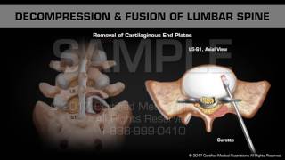 Decompression amp Fusion of Lumbar Spine [upl. by Nywra711]