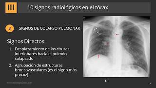 10 Signos Radiológicos en el Tórax [upl. by Shererd]