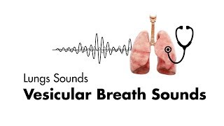 The Lung Sounds of Pneumonia [upl. by Archangel]