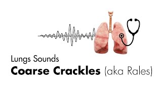 Bronchitis Symptoms Causes Treatments  Dr MyHuyen Tran [upl. by Nevag261]