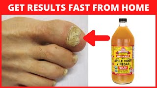 Apple Cider Vinegar for Toenail Fungus [upl. by Nnylkcaj]