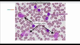 Chronic Lymphocytic Leukemia CLL [upl. by Aissert]